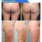 Endospheres roller massage cellulite machine