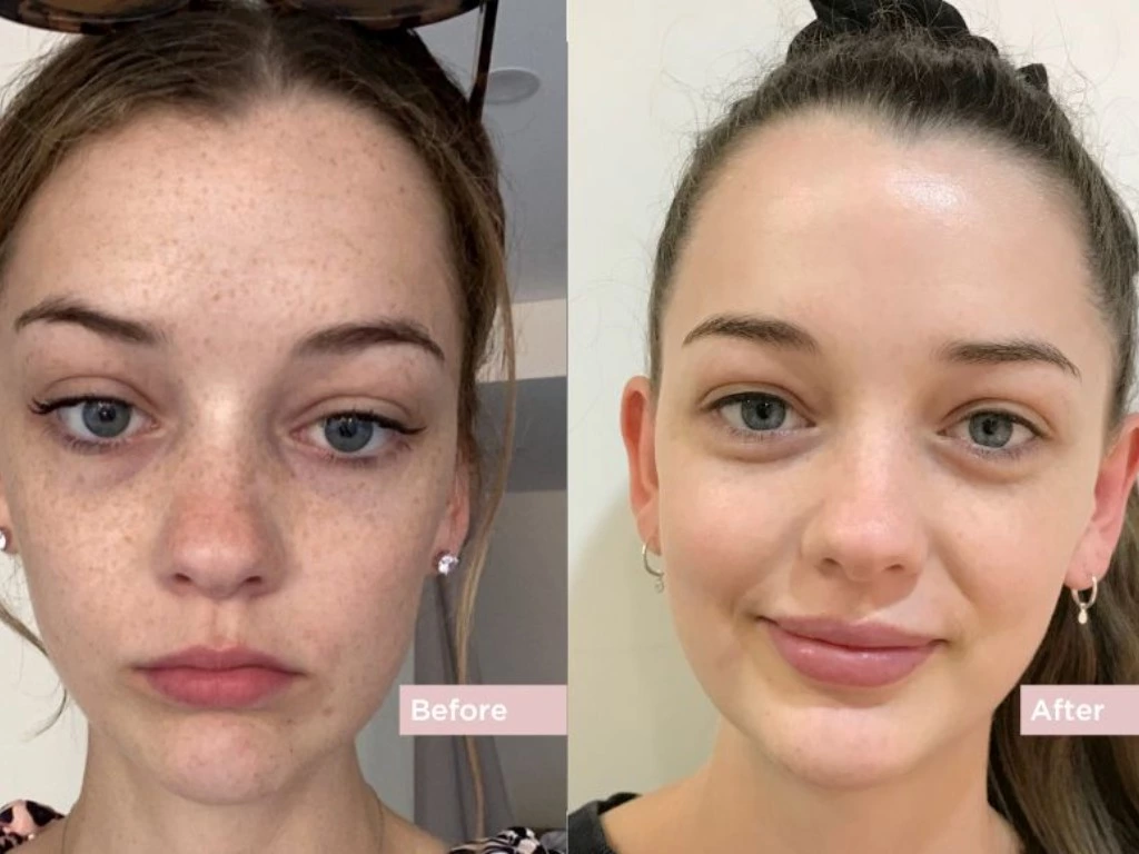 Pigmentation Removal Treatment