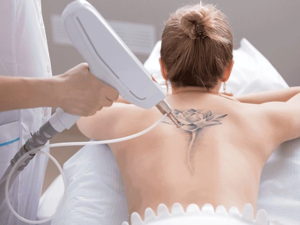 Tattoo Removal