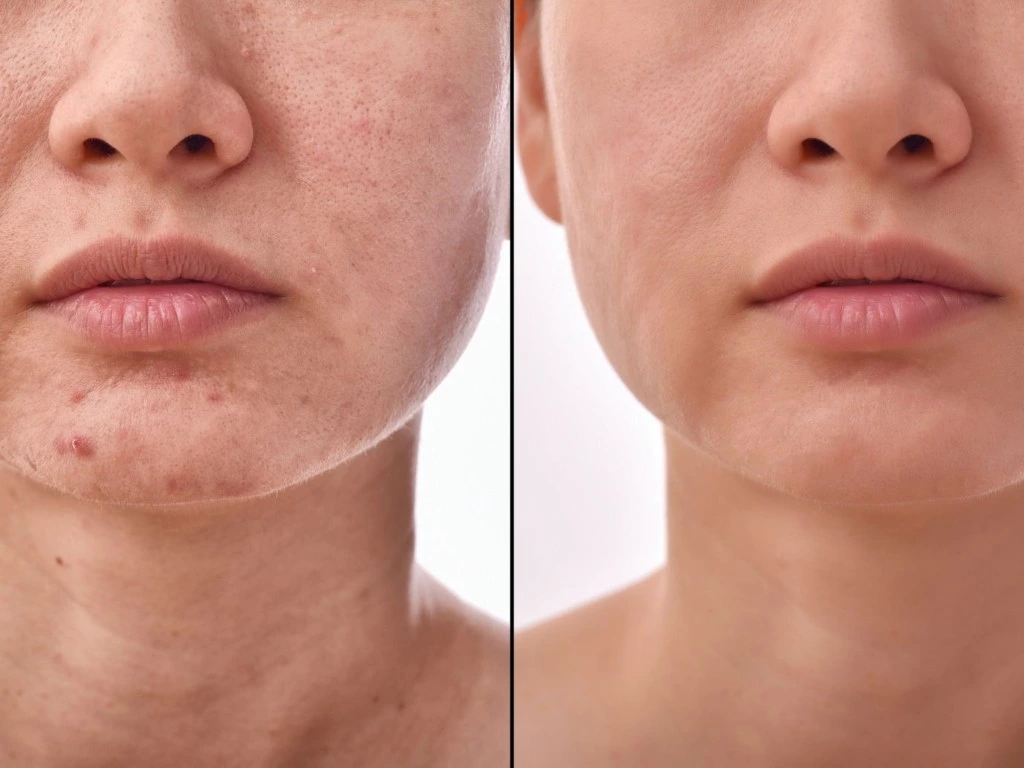 Scar removal treatments