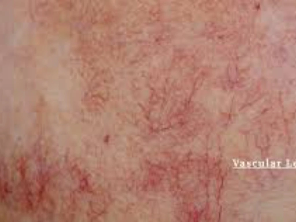 Vascular Lesions treatments
