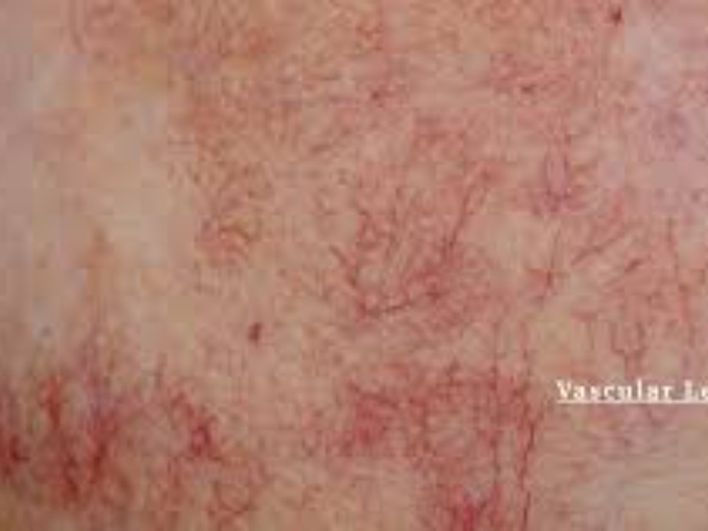 Vascular Lesions treatments