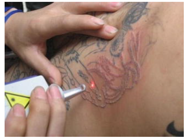 Q-Switched nd-yag Laser