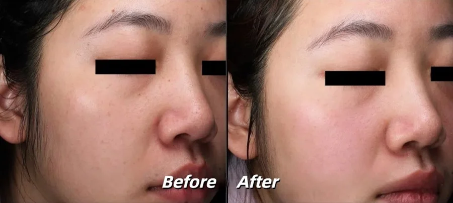 1927 Thulium Laser Skin Tightening Before and After Photos