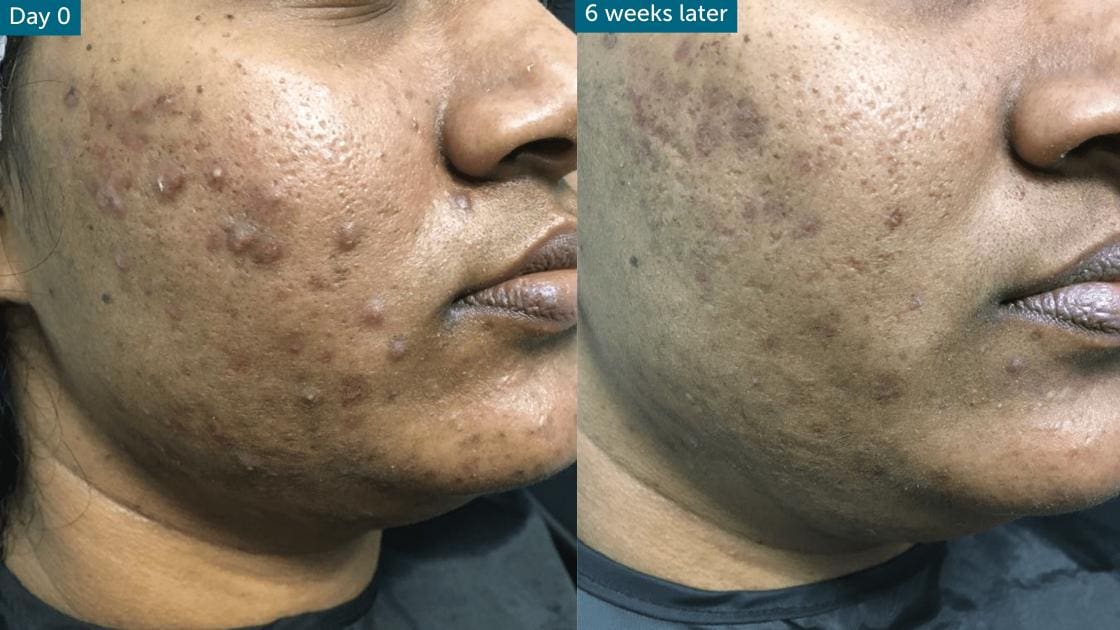 Before and after treatment of acne with 1927nm thulium laser