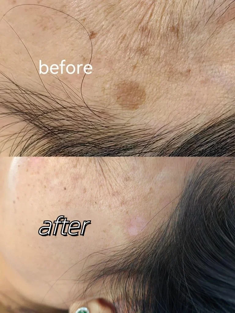 Comparison pictures before and after treatment of age spots