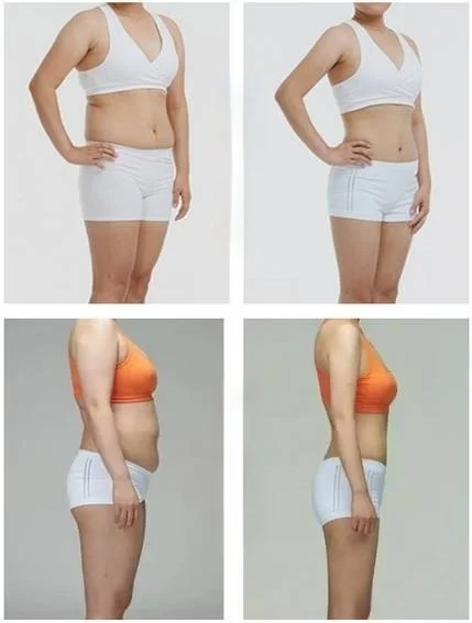 Fat cavitation treatment before and after picture