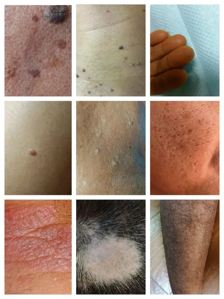 Fractional CO2 laser skin medical application pictures