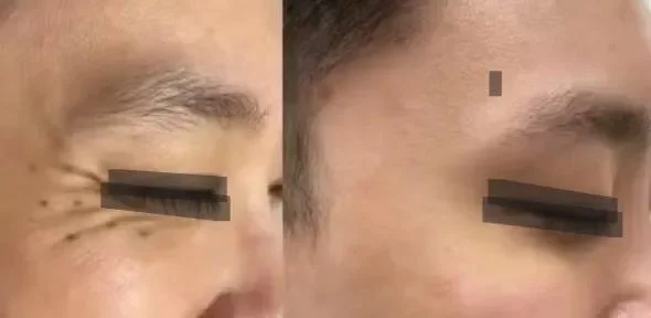 Fractional CO2 laser to remove wrinkles around the eyes before and after one week