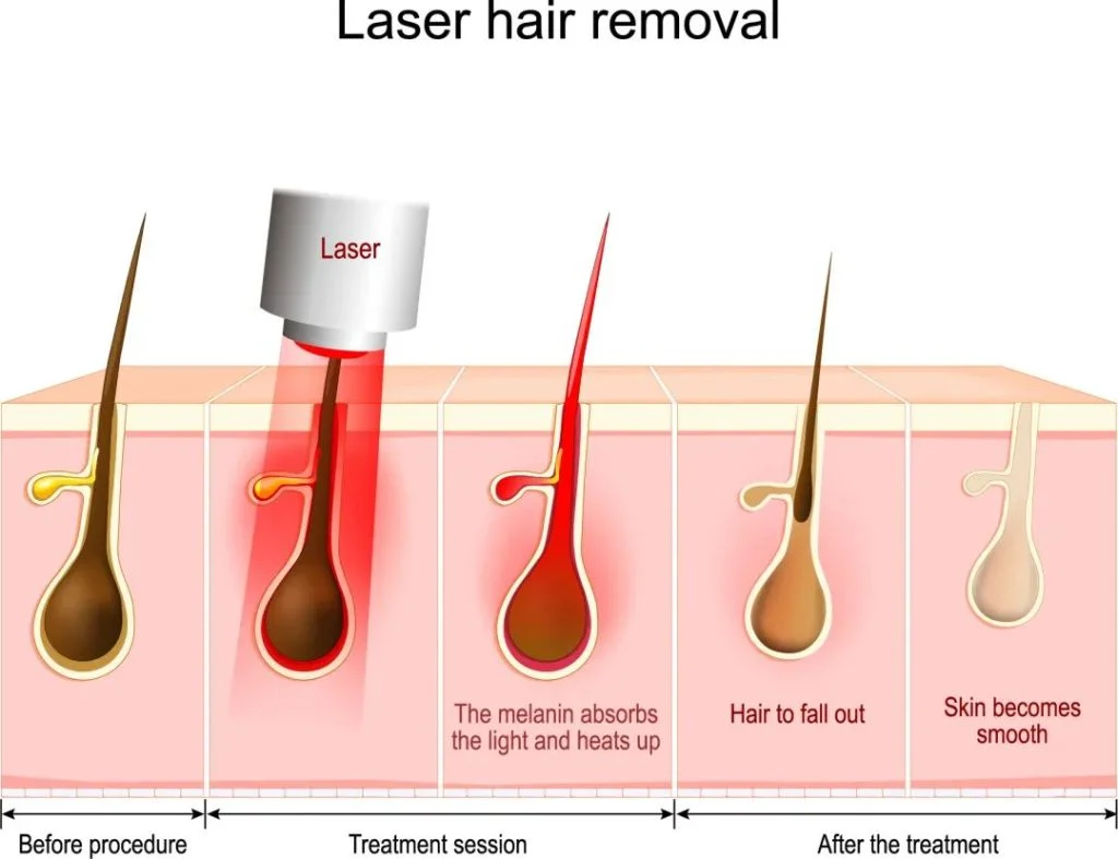 MBS IPL Laser Machine (Hair Removal & Skin Rejuvenation)