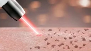 Laser removal of black tattoo pigment particles detailed chart