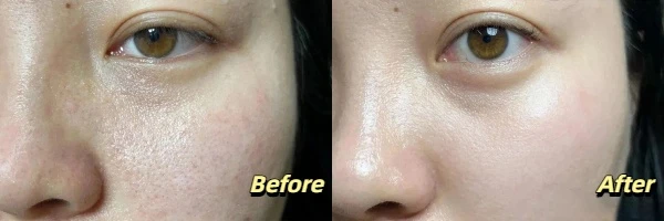 Laser Whitening Before and After Photos