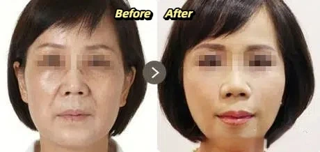 Laser wrinkle removal before and after photos