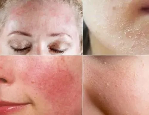 Skin problems caused by damaged skin barrier.