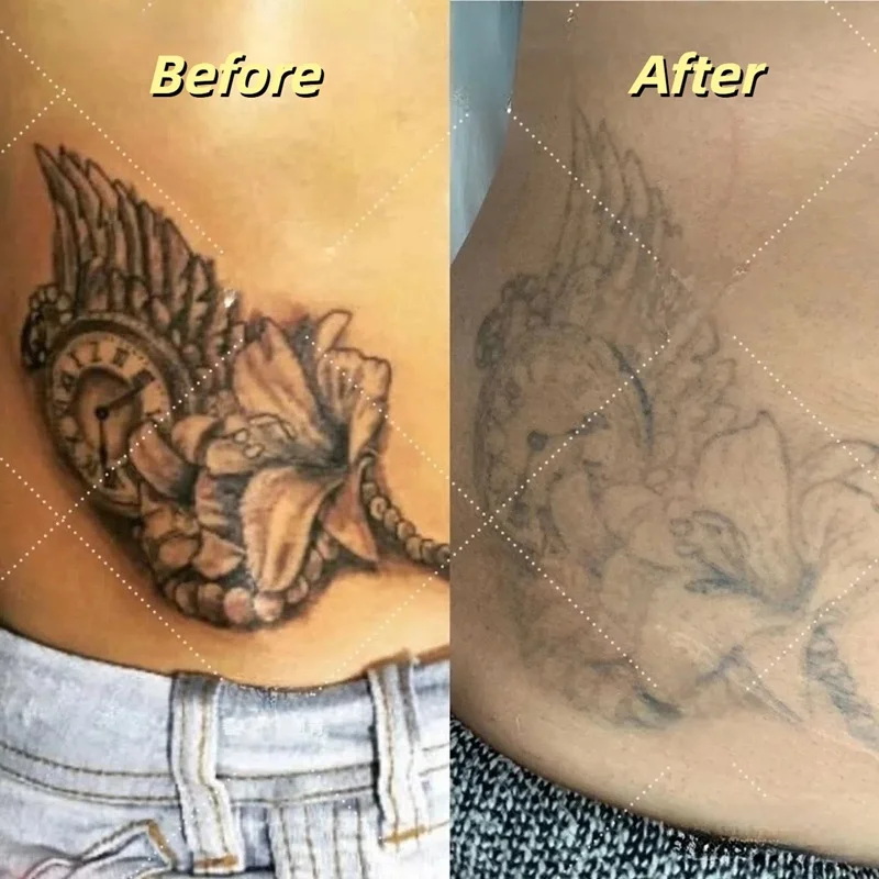 Tattoo removal before and after 1 session