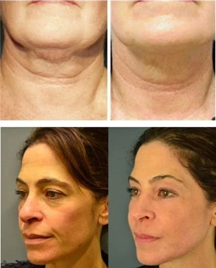 monopolar-radiofrequency-skin-tightening-before-and-after