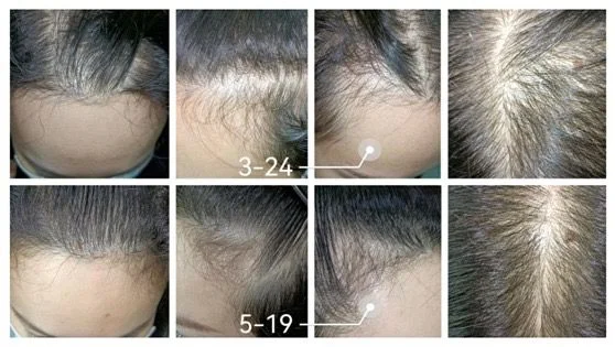 Fractional 1927nm Thulium Laser Hair Growth Therapy