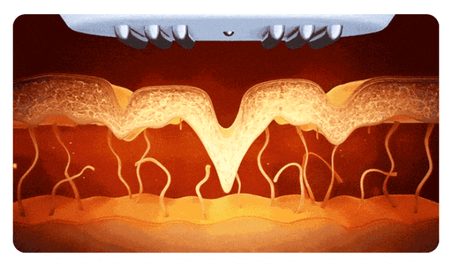 Ultrasound animation of fat cavitation