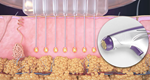 Rf Microneedle Scarring Removal Skin Tightening  Rf Microneedling Machine