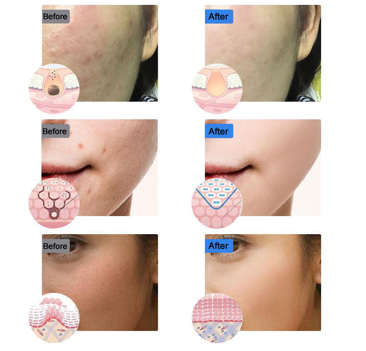 7 Color PDT Light Therapy Machine for Face Acne Care