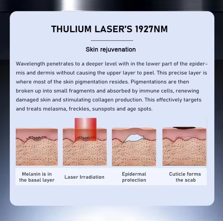 Thulium Laser 1927nm High Efficiency Fractional Laser for Acne Removal
