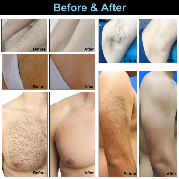 2 in 1  755 808 1064nm Triple Wavelength Laser for Hair Removal