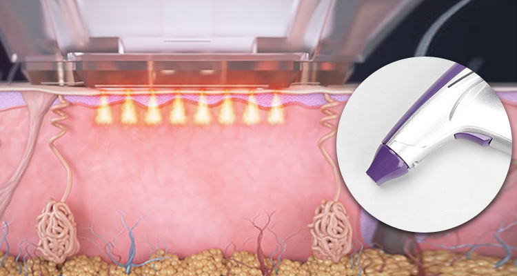 Rf Microneedle Scarring Removal Skin Tightening Rf Microneedling Machine
