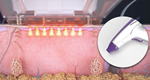 Rf Microneedle Scarring Removal Skin Tightening  Rf Microneedling Machine