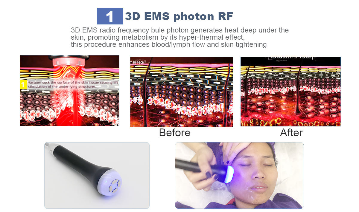 Portable Ultrasound Cavitation Radio Frequency EMS 40k Cavitation Machine