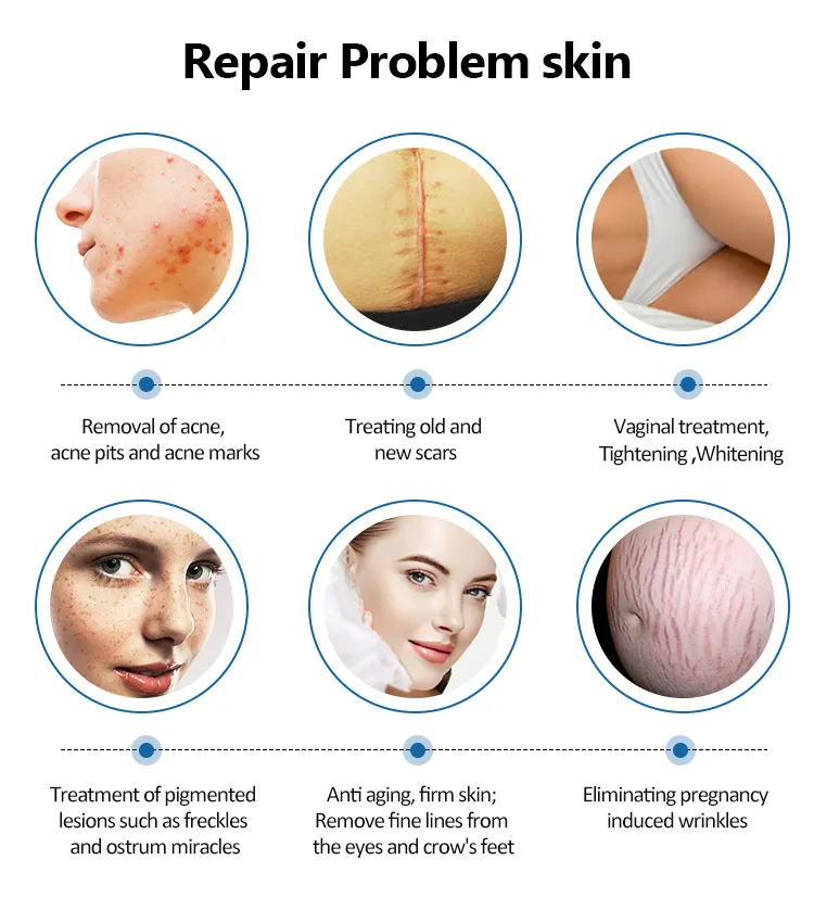 Portable Co2 Fractional Laser Acne Scar Removal  Machine