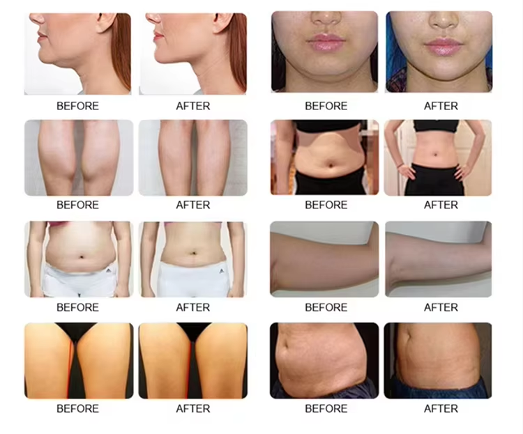 5 in 1 Cryolipolysys Fat Reduce 360 Cellulite Reduction  Machine
