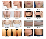 5 in 1 Cryolipolysys Fat Reduce 360 Cellulite Reduction  Machine
