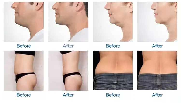 5 in 1 Cryolipolysys Fat Reduce 360 Cellulite Reduction  Machine