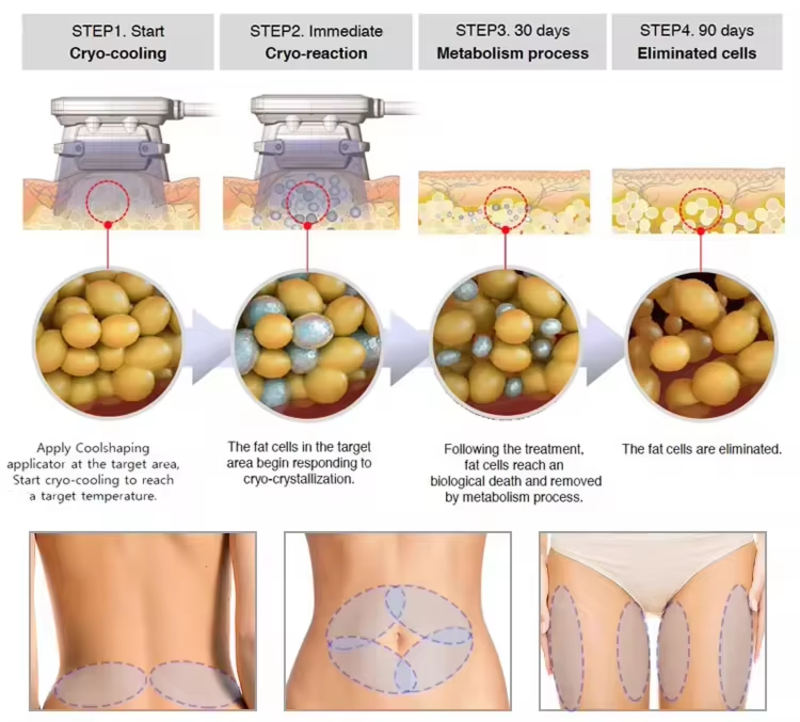 4 Handles Multifunctional Body Shape 360 Cool Cryolipolysis Slimming Machine