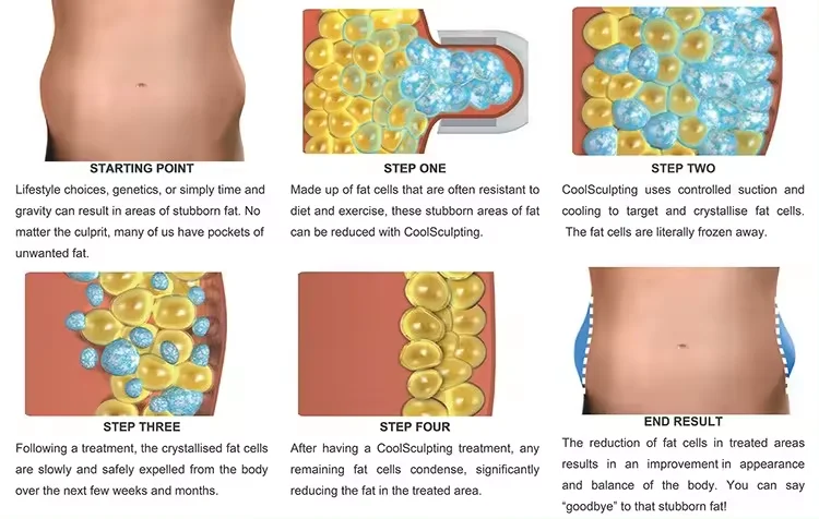 5 in 1 Cryolipolysys Fat Reduce 360 Cellulite Reduction  Machine