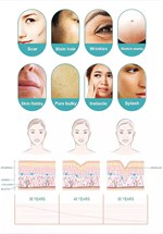 Fractional RF Skin Tightening & Scar Removal Device with 4 Tips