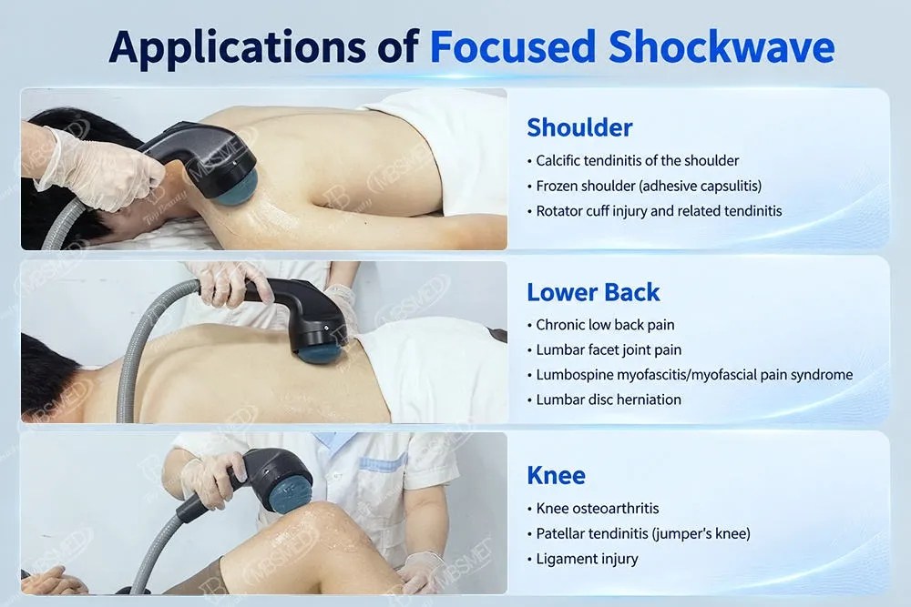 Deepwave Gen 3 Electromagnetic Focused Shockwave Machine Calcific Fibroblasts