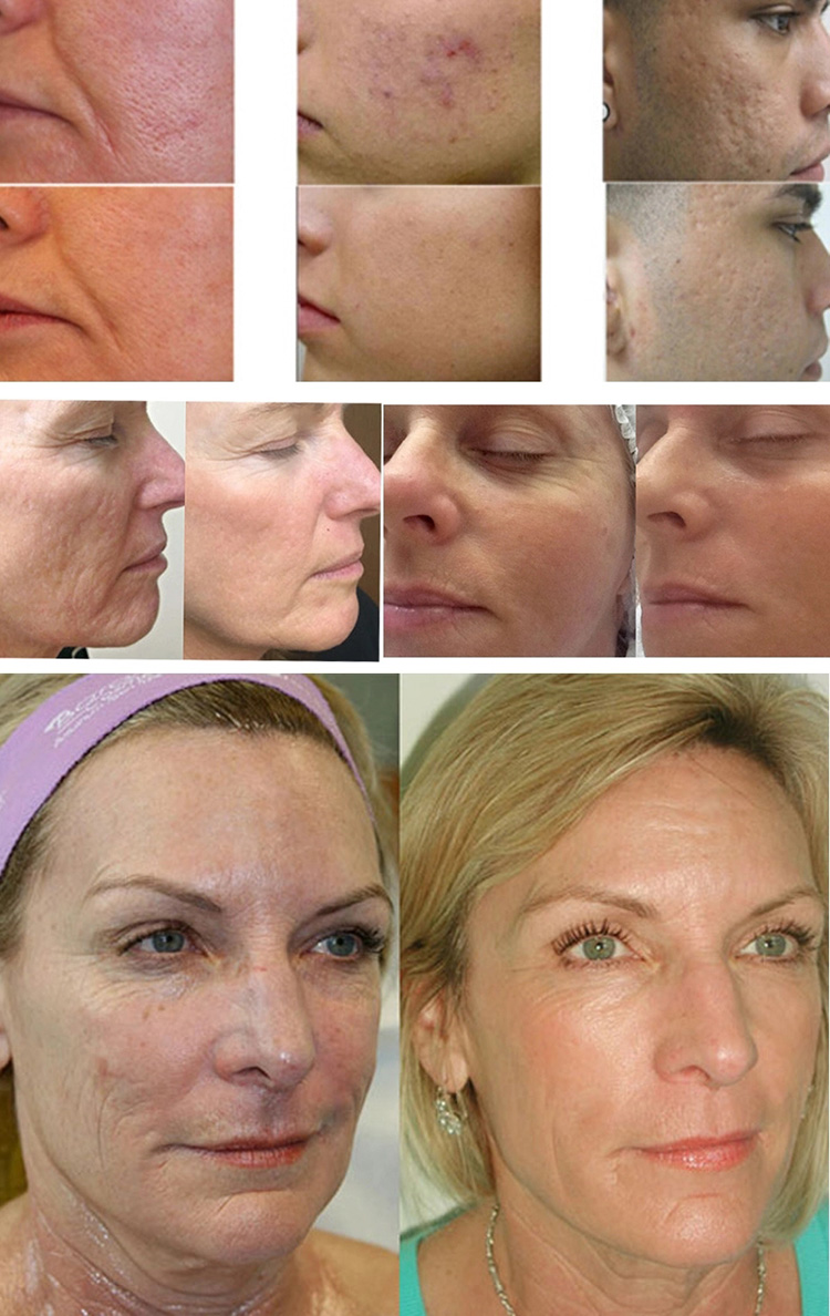 Fractional Rf Anti Aging Face Lifting Skin Tightening Machine