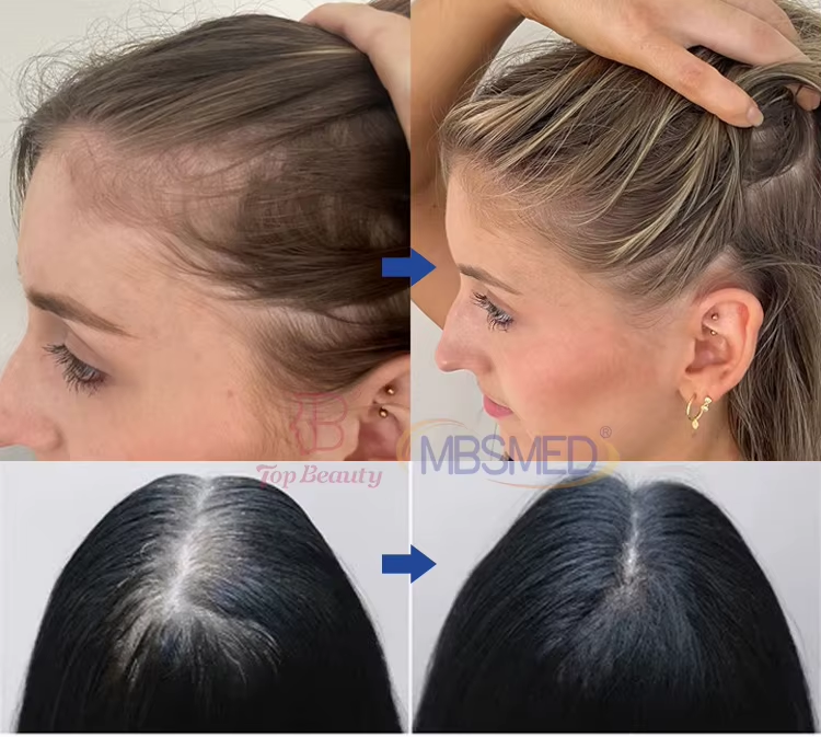 4 In 1 TECAR 448khz Hair Loss Treatment Machine