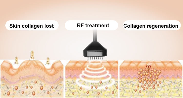 4 In 1 TECAR 448khz Hair Loss Treatment Machine