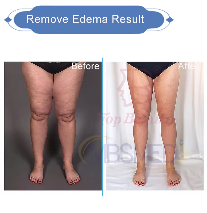 3 in 1 Infrared EMS Pressotherapy Body Slimming Suit Lymphatic Drainage Machine