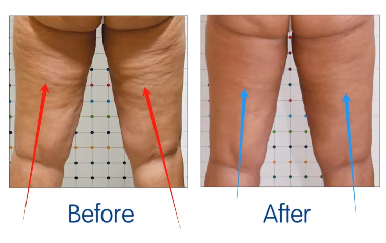Coolwave Facial and Body Sculpting Coolwave Device for Wrinkle Reduction And Slimming