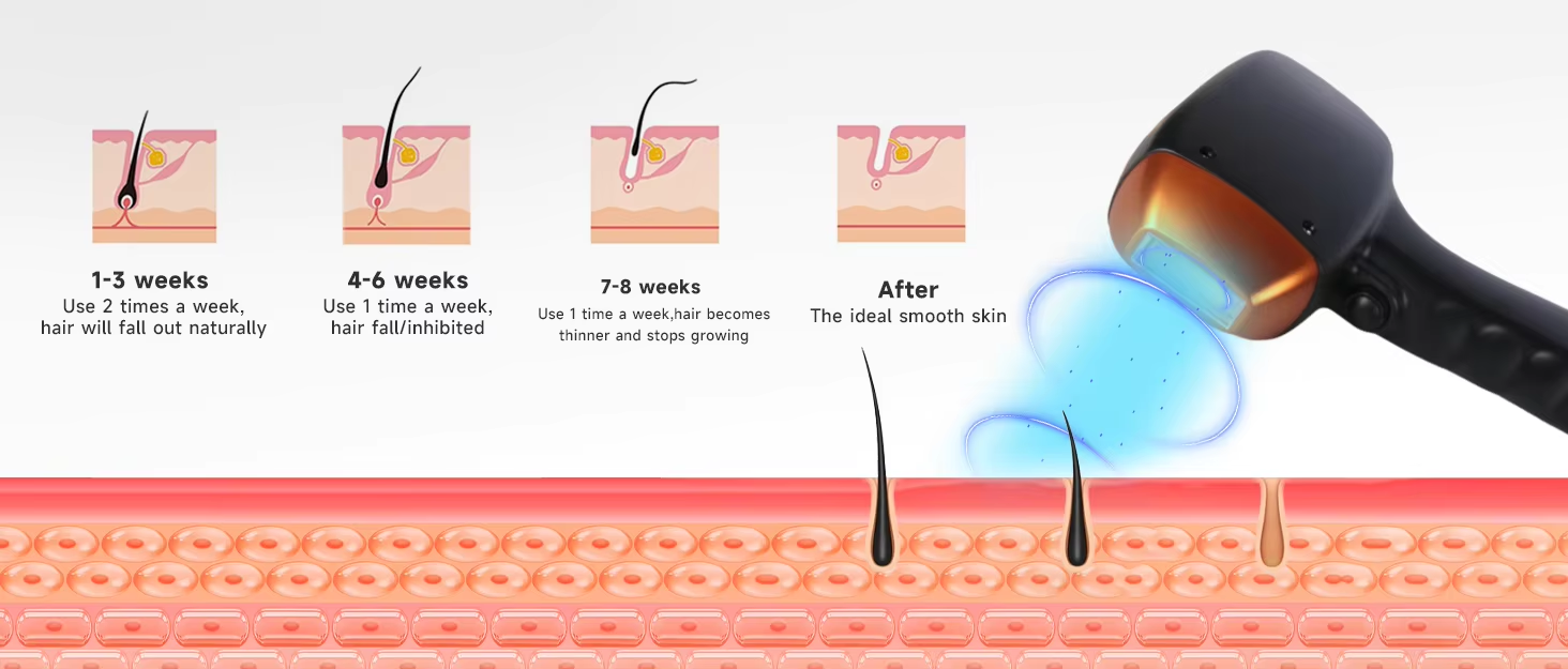 3 Wavelengths 808nm Diode Laser 755 808 1064 Diode Laser Hair Removal Machine