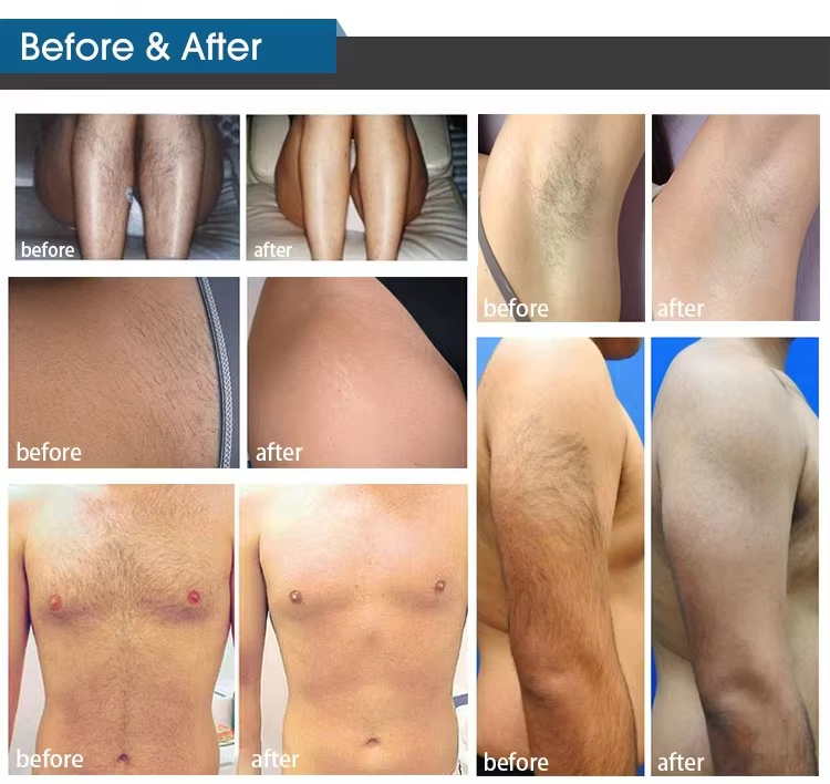 3 Wavelengths 808nm Diode Laser 755 808 1064 Diode Laser Hair Removal Machine