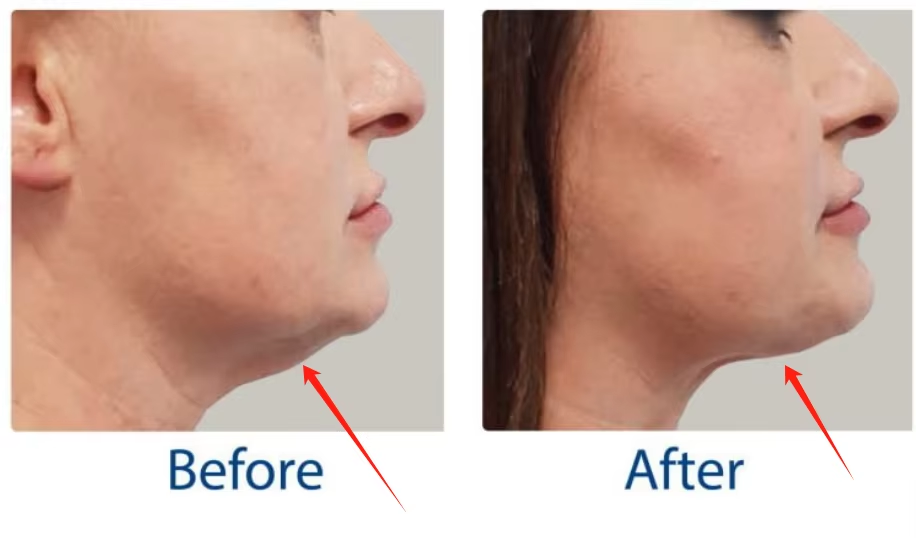 Coolwave Facial and Body Sculpting Coolwave Device for Wrinkle Reduction And Slimming