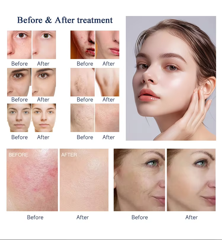 New Design DPL NIR Skin Whitening Spot Removal Skin Rejuvenation Laser Machine