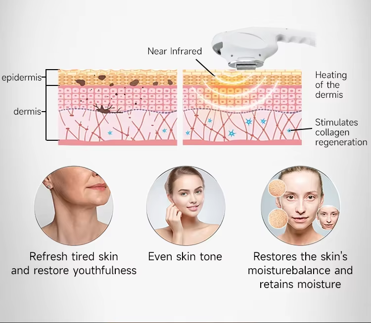 New Design DPL NIR Skin Whitening Spot Removal Skin Rejuvenation Laser Machine