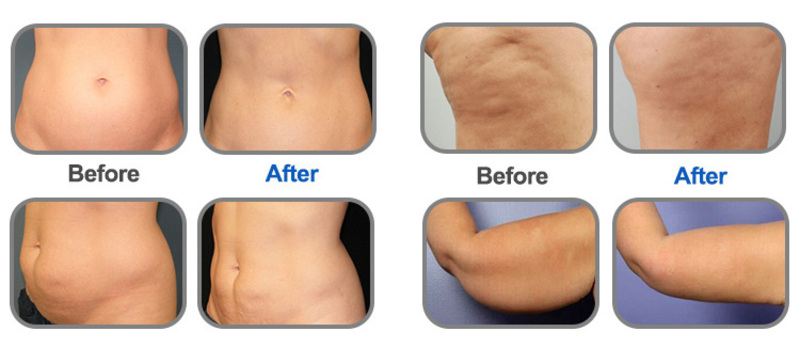 Shock Wave Device Eswt Cellulite Weight Loss Shockwave Therapy Machine