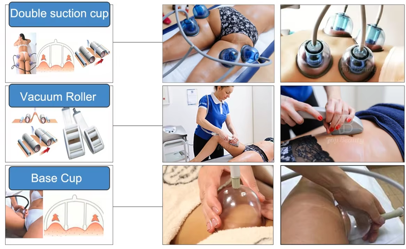 Starvac Sp2 Cellulite Weight Loss Body Slimming Vacuum Therapy Machine